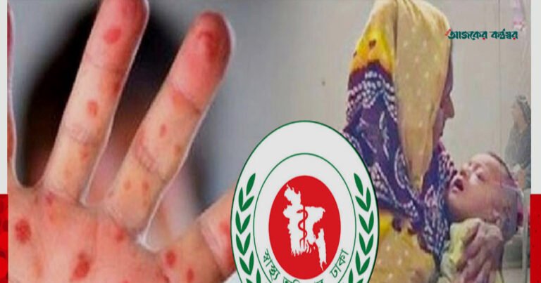 হাম ও উপসর্গে দেশে আরও ৬ শিশুর মৃত্যু, শনাক্ত ১২১৩