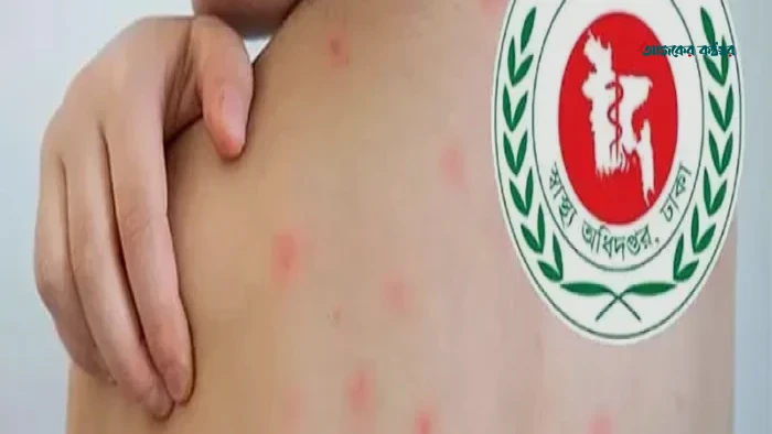 হাম ও উপসর্গে দেশে মোট মৃত্যু ১২০১ জন