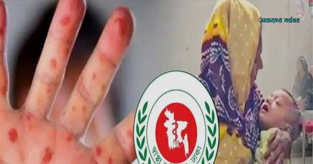 হামের উপসর্গে আরও দুই শিশুর মৃত্যু, মোট প্রাণহানি ১২৫১